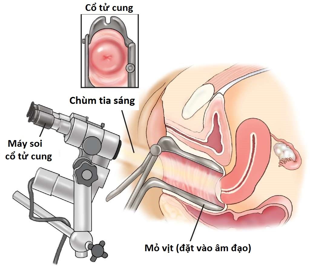 Soi cổ tử cung có phát hiện ung thư không